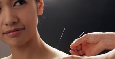 Mulher sendo tratada por agulha acupuntura