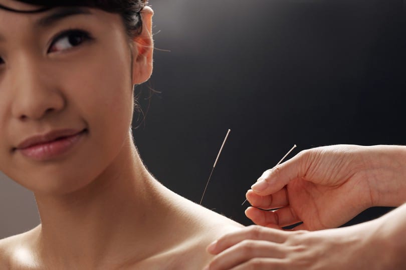 Mulher sendo tratada por agulha acupuntura