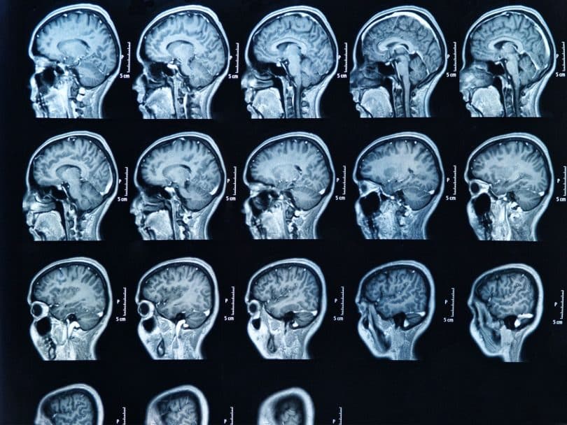 Imagem por ressonância magnética do cérebro.