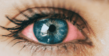 Imagem de um olho com vermelhidão