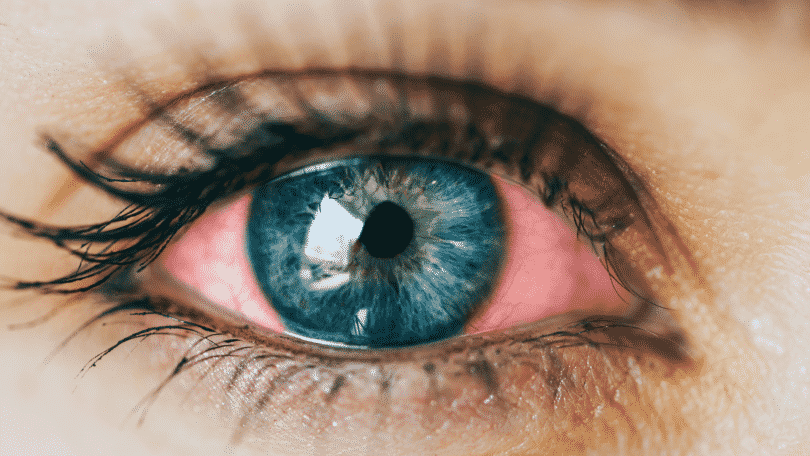 Imagem de um olho com vermelhidão