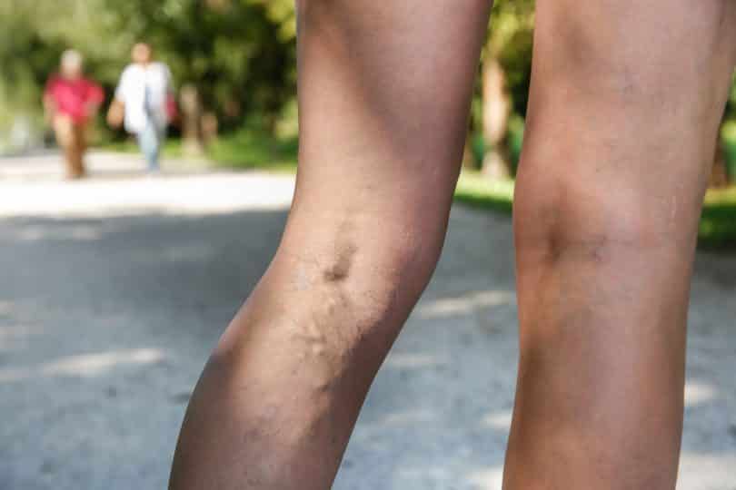 Pernas de uma mulher com varizes