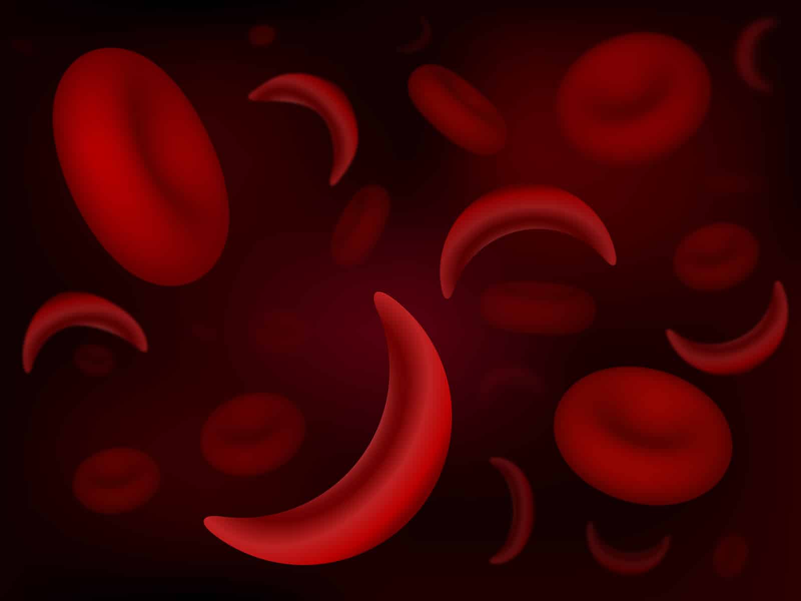 Sickle-cell and normal red blood cells