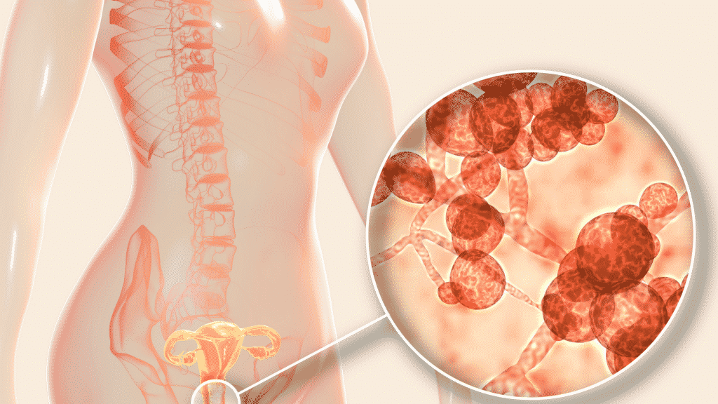 Representação da candidíase no sistema reprodutor feminino