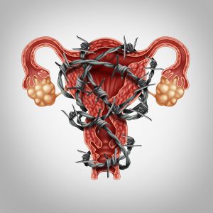 Uterus and abdominal pain medical concept with painful barbed wire wrapped on the anatomy as an endometriosis problem with the human female reproduction symbol as a symbol of fertility and reproductive system disease or illness.