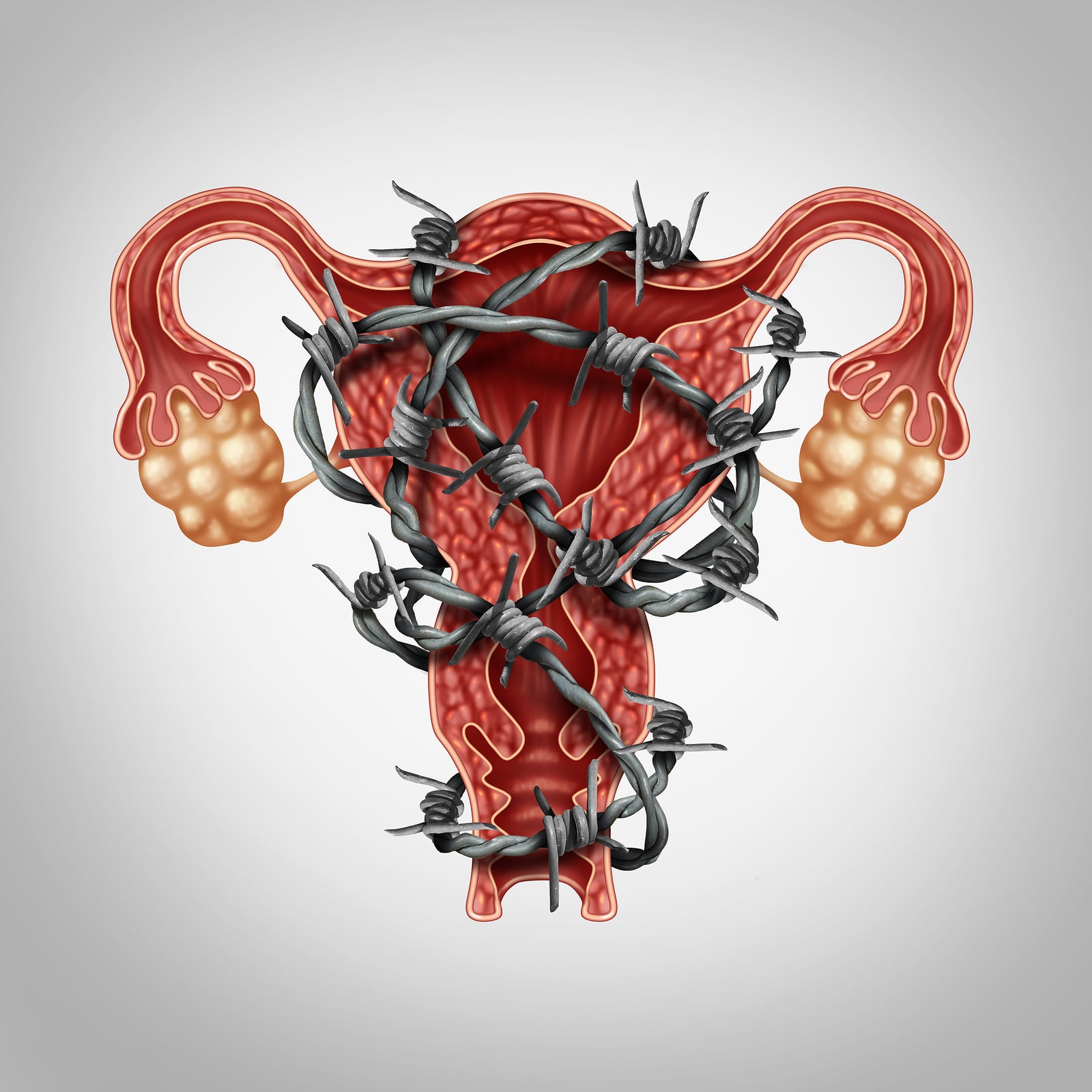 Uterus and abdominal pain medical concept with painful barbed wire wrapped on the anatomy as an endometriosis problem with the human female reproduction symbol as a symbol of fertility and reproductive system disease or illness.