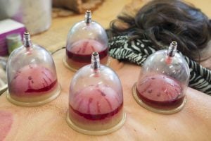 cupping was an ancient traditional chinese medicne