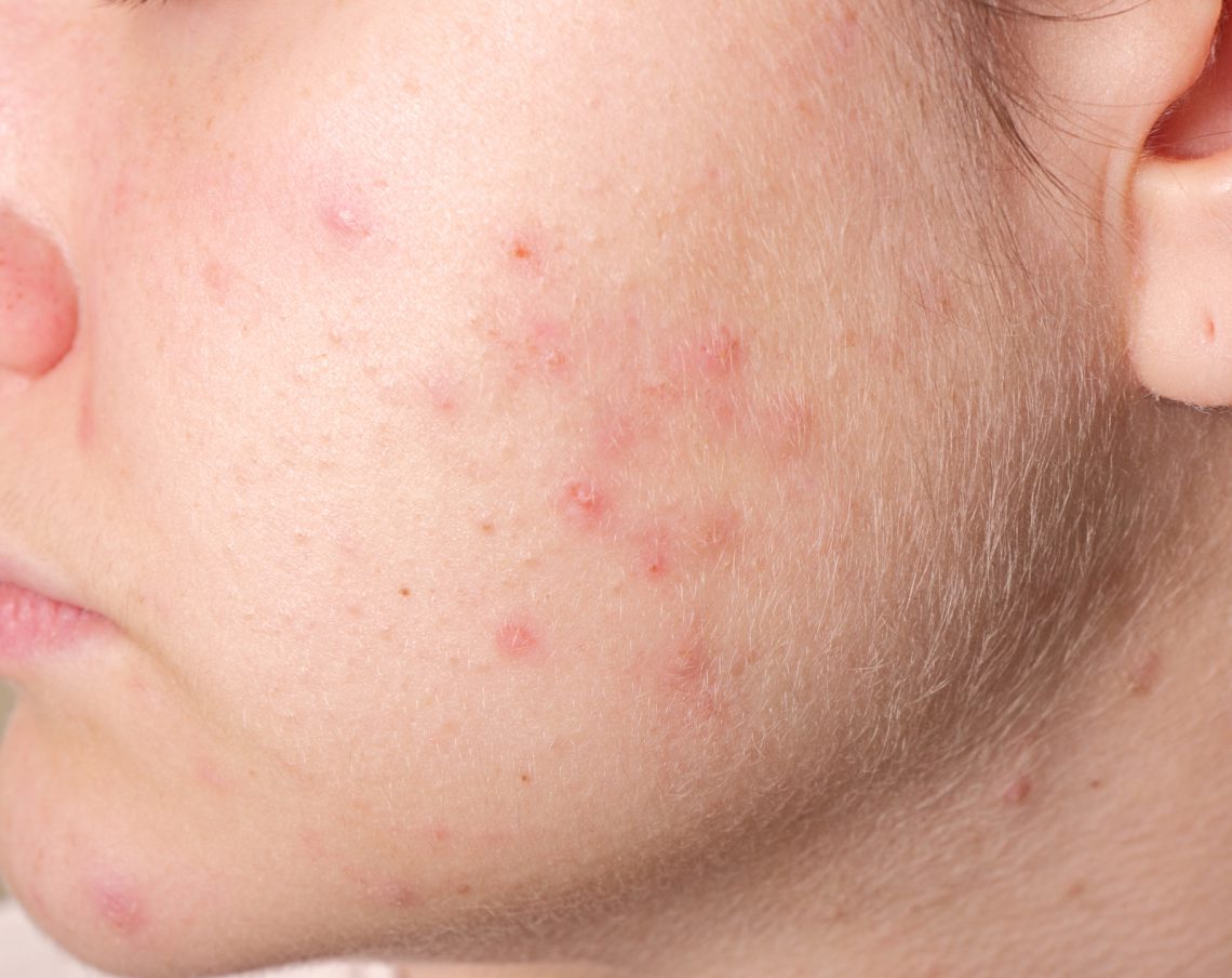 O que a sua acne revela sobre você? Eu Sem Fronteiras