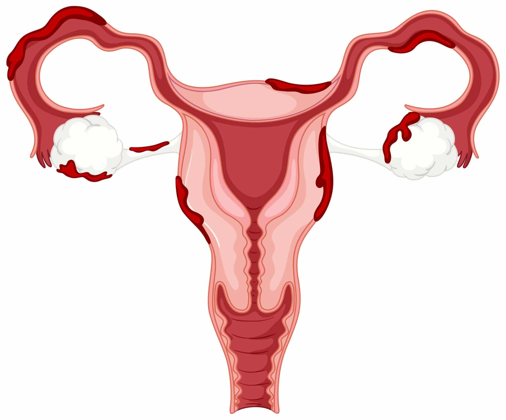 endometriose