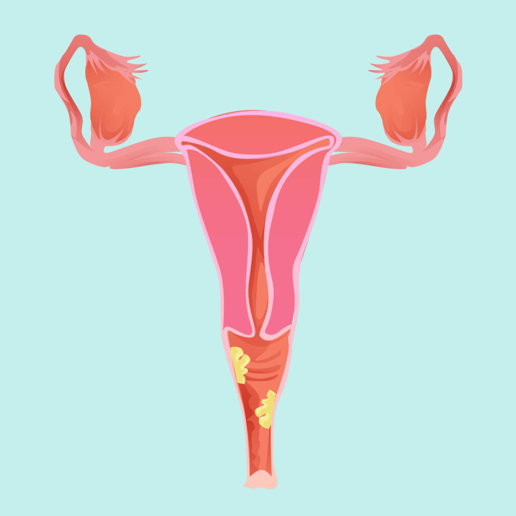 Desenho gráfico para exemplificar o que é endometriose. Vetor de uma vagina nas cores rosa e vermelho.