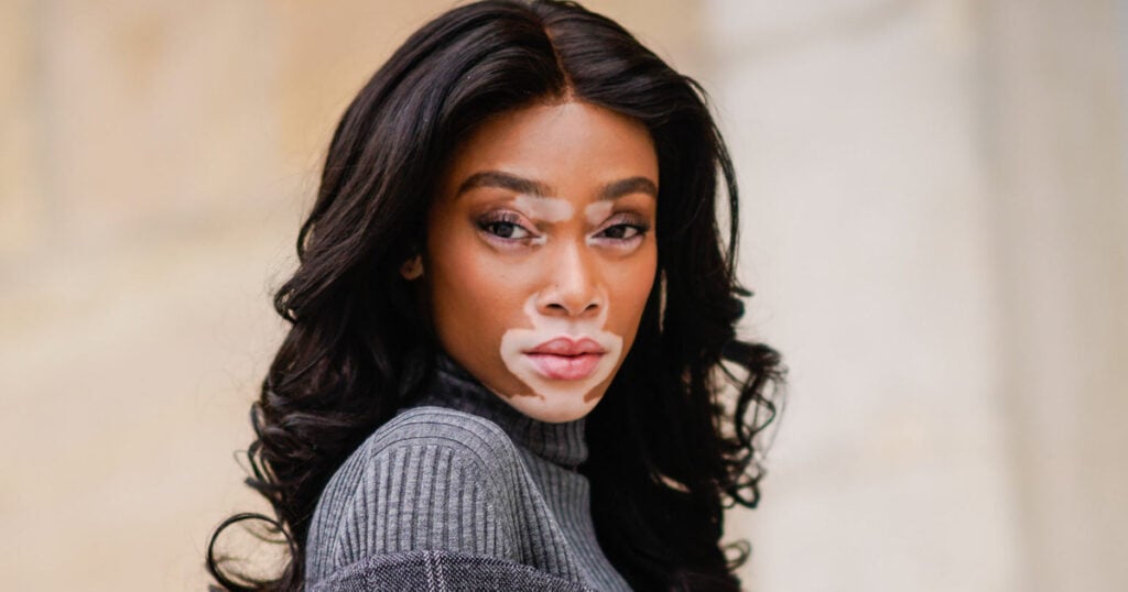 Fotografia da modelo Winnie Harlow.