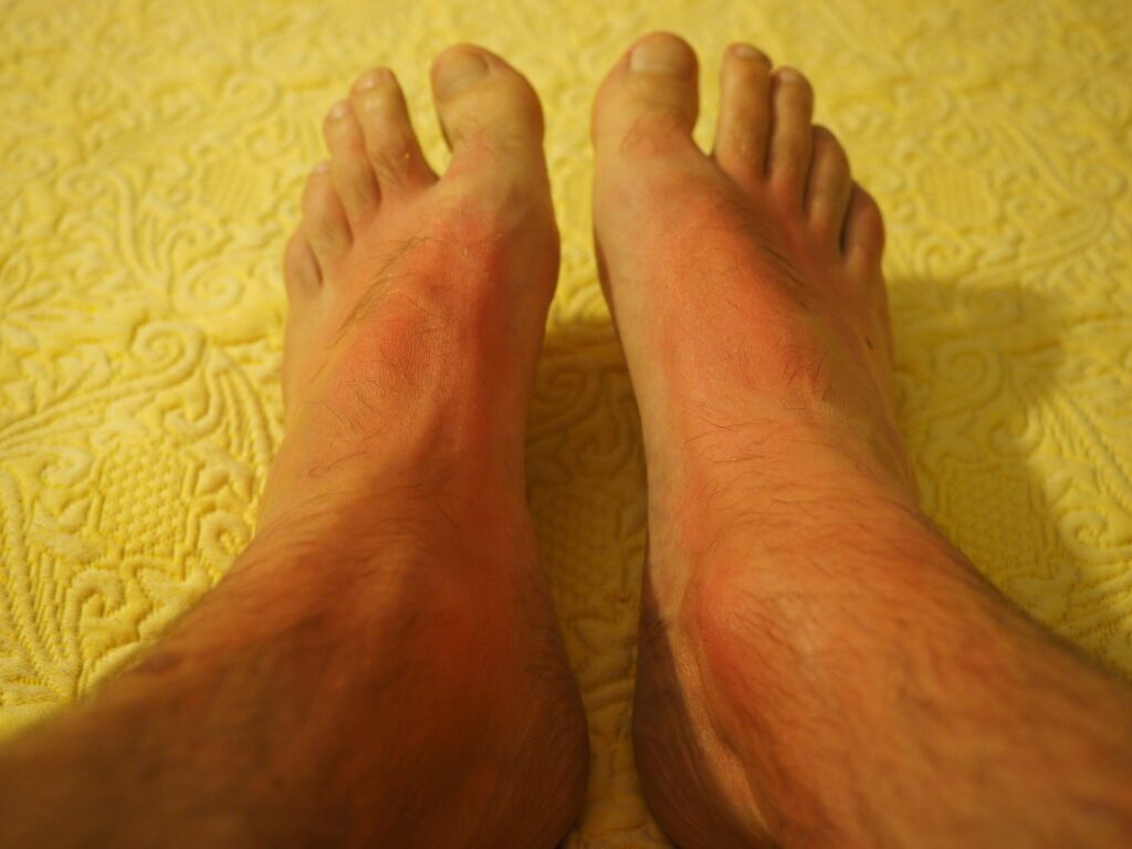 Imagem de dois pés masculinos apresentando queimadura solar de primeiro grau.