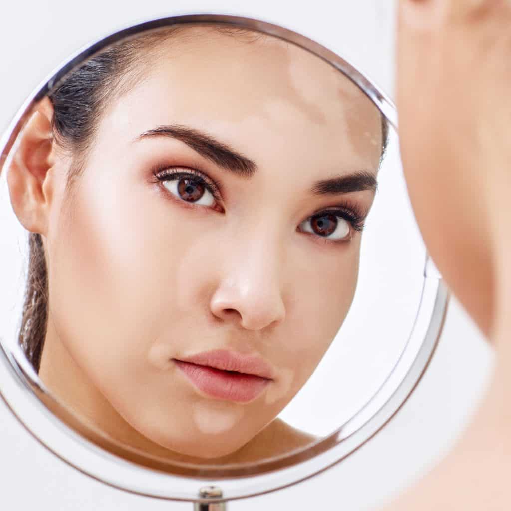 Imagem do rosto de uma mulher, manchado devido à doença do vitiligo. A imagem dela está refletida em um espelho.