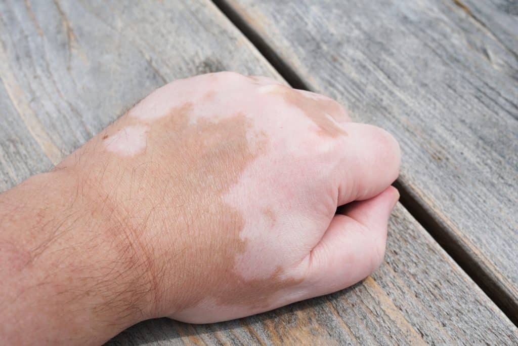 Imagem da mão de um homem manchada devido a doença do vitiligo.
