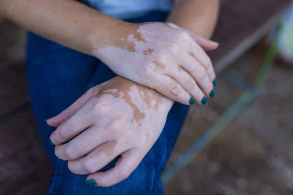 Imagem das mãos de uma mulher  com manchas da doença vitiligo.

