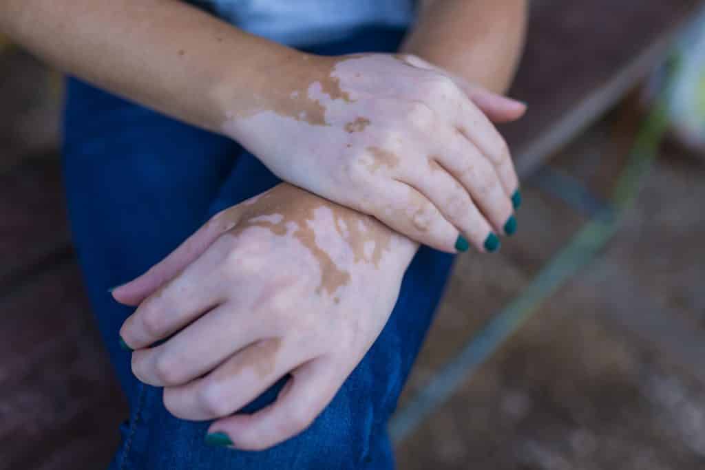 Imagem das mãos de uma mulher  com manchas da doença vitiligo.