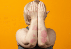 Mulher loira mostrando os braços com manchas de psoríase.
