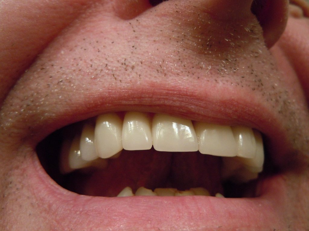 Featured image of post Sonhar Com Dente Quebrando Entenda o significa de sonhar com dente quebrado e suas poss veis interpreta es que podem apontar um caminho para entender seus sonhos