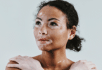 Mulher com vitiligo com as mãos no ombro, olhando ao redor.
