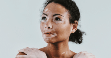 Mulher com vitiligo com as mãos no ombro, olhando ao redor.