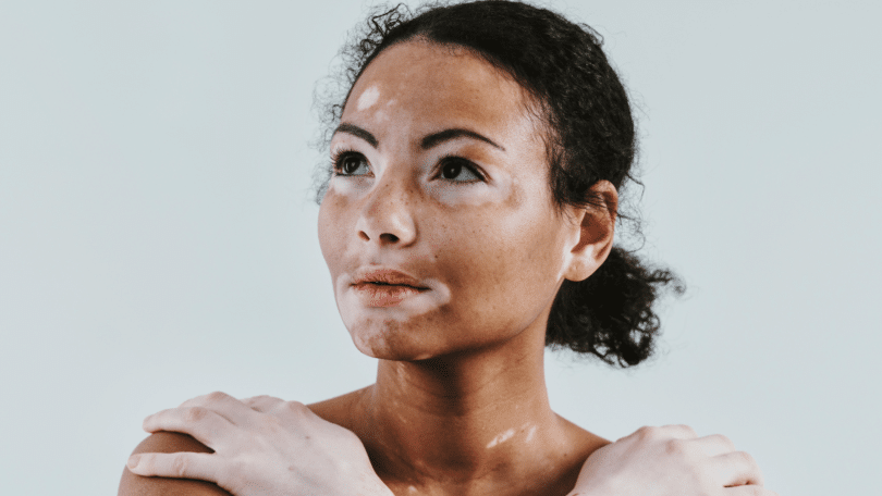 Mulher com vitiligo com as mãos no ombro, olhando ao redor.