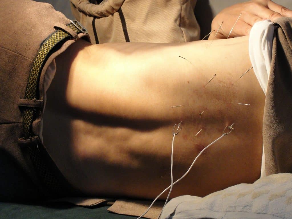 Imagem de um homem fazendo acupuntura. Ele está deitado sobre uma maca. A acupuntura está sendo feita nas costas.
