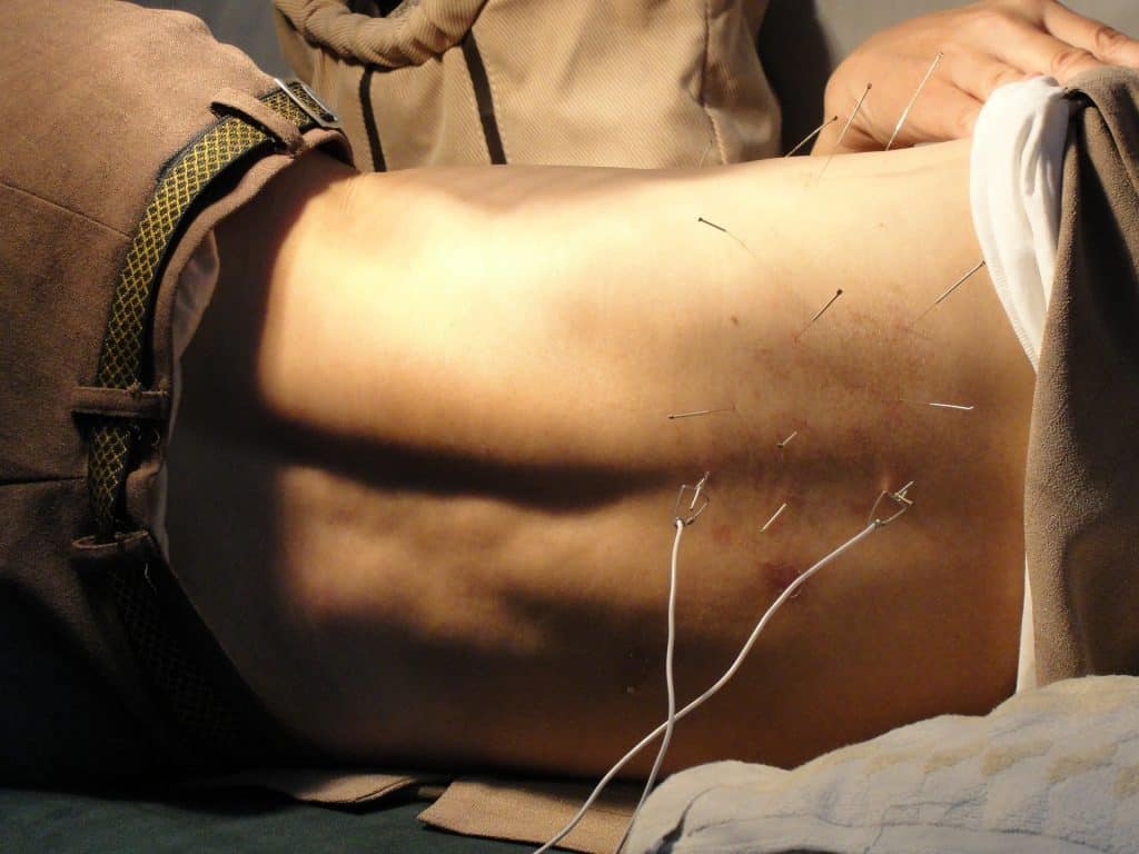 Imagem de um homem fazendo acupuntura. Ele está deitado sobre uma maca. A acupuntura está sendo feita nas costas.
