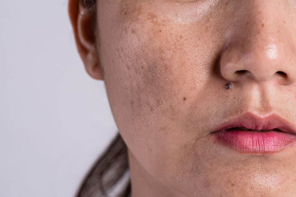 Mulher com verruga e cicatrizes de acne na pele