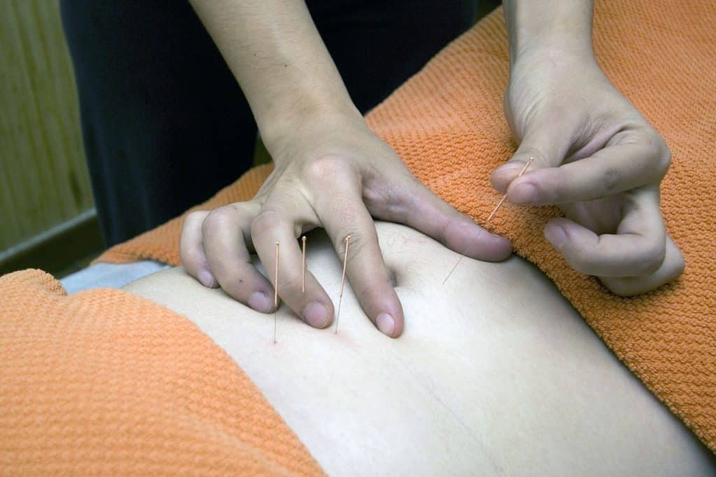 Terapeuta aplicando agulhas de acupuntura em paciente