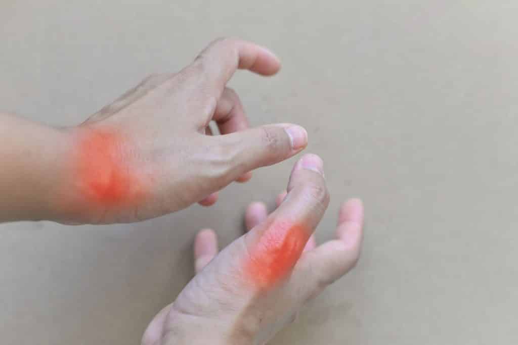 Mãos com manchas vermelhas sinalizando dor.