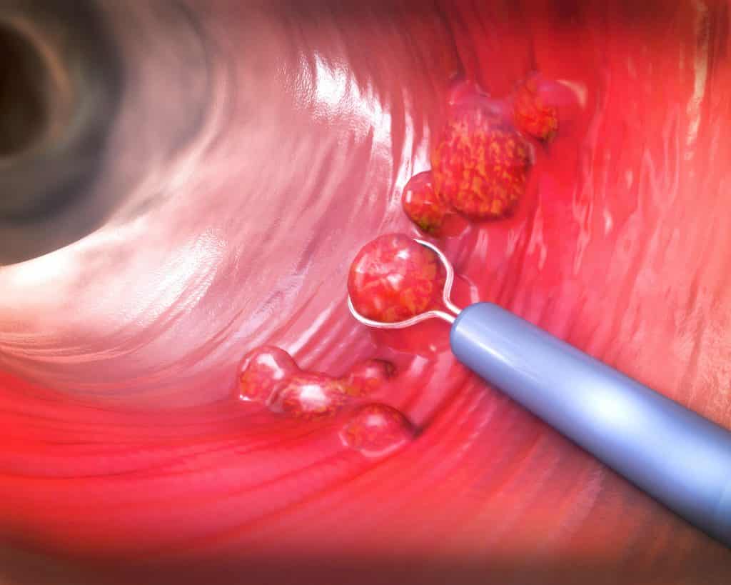 Remoção de um pólipo colônico com uma alça de fio elétrico durante uma colonoscopia - ilustração 3D
