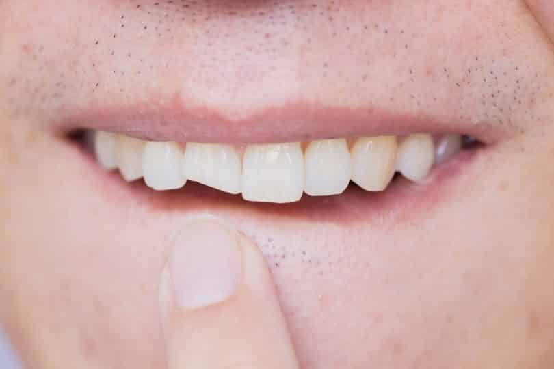 Homem apontando o seu dente quebrado