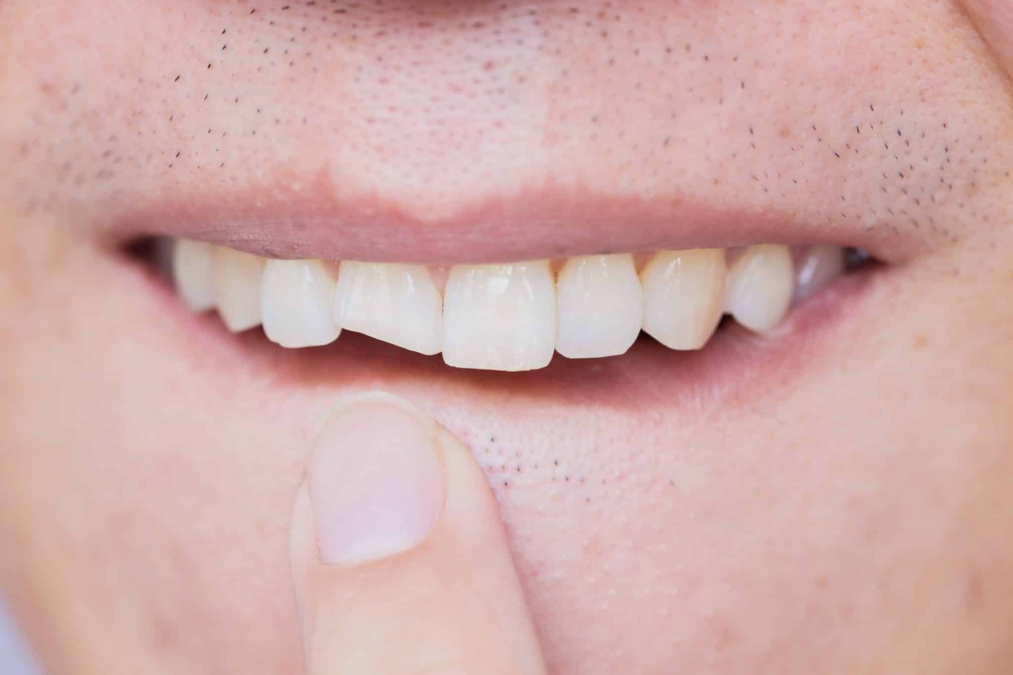 Significado de sonhar com dente podre caindo. Compreenda-o!