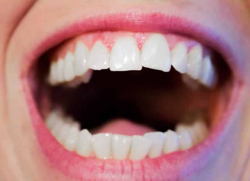 Uma boca sendo exibida de perto com dentes levemente tortos.
