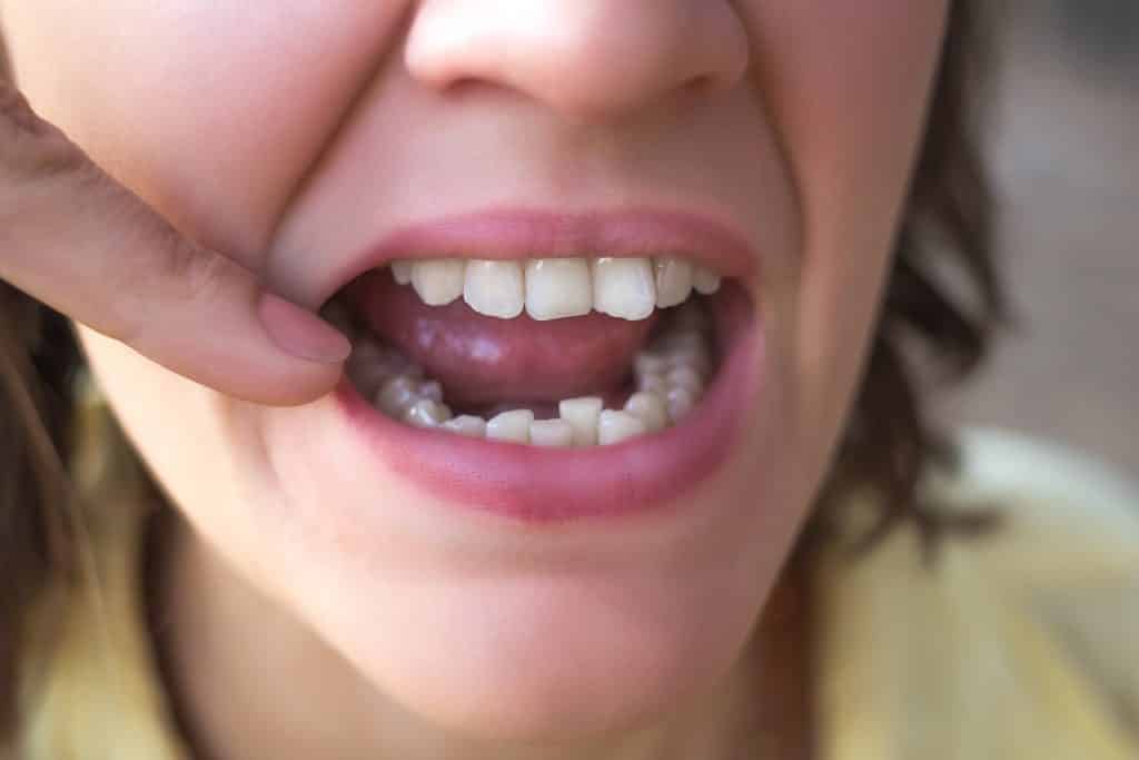 Uma mulher exibindo sua boca com alguns dentes tortos.