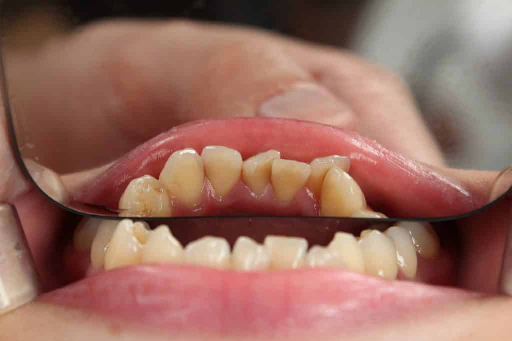 Dentes tortos sendo exibidos em um espelho, vistos de cima.