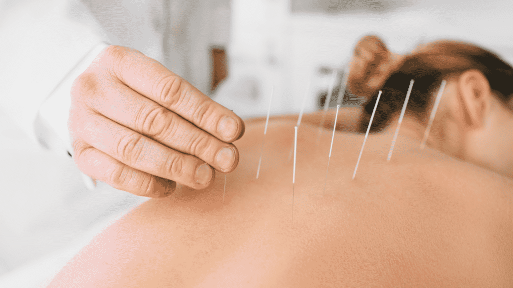 Terapeuta aplicando agulhas de acupuntura nas costas de uma paciente