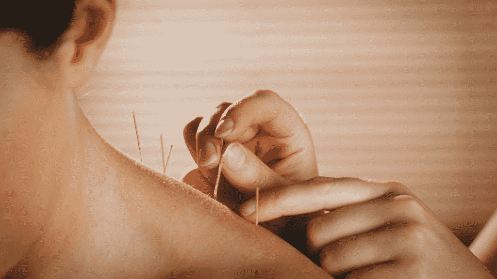 Terapeuta aplicando agulhas de acupuntura no ombro de um paciente