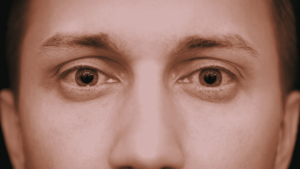 Homem com os dois olhos vermelhos
