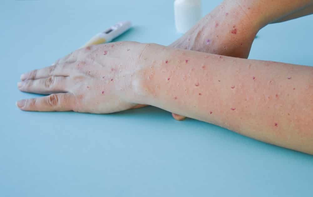 Mãos de alguém infectado com varíola com vários machucados na pele