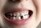 Uma criança cujo sorriso falta-lhe um dente.