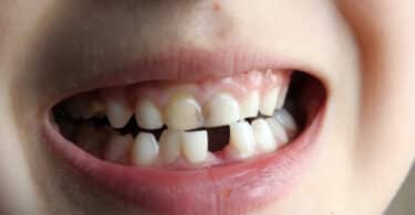 Uma criança cujo sorriso falta-lhe um dente.