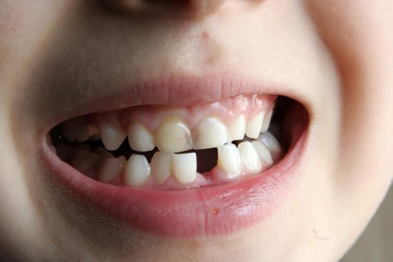 Uma criança cujo sorriso falta-lhe um dente.
