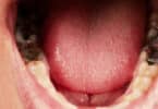 Imagem de dentes podres na boca de uma pessoa