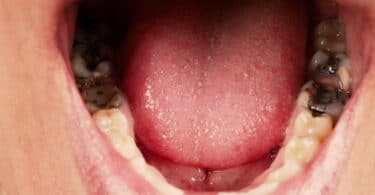 Imagem de dentes podres na boca de uma pessoa