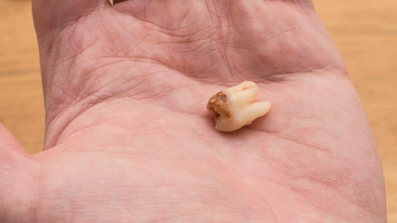 Imagem de um dente podre na mão de uma pessoa