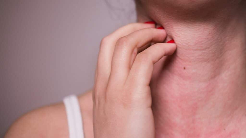 Imagem do pescoço de uma mulher que está com alergia