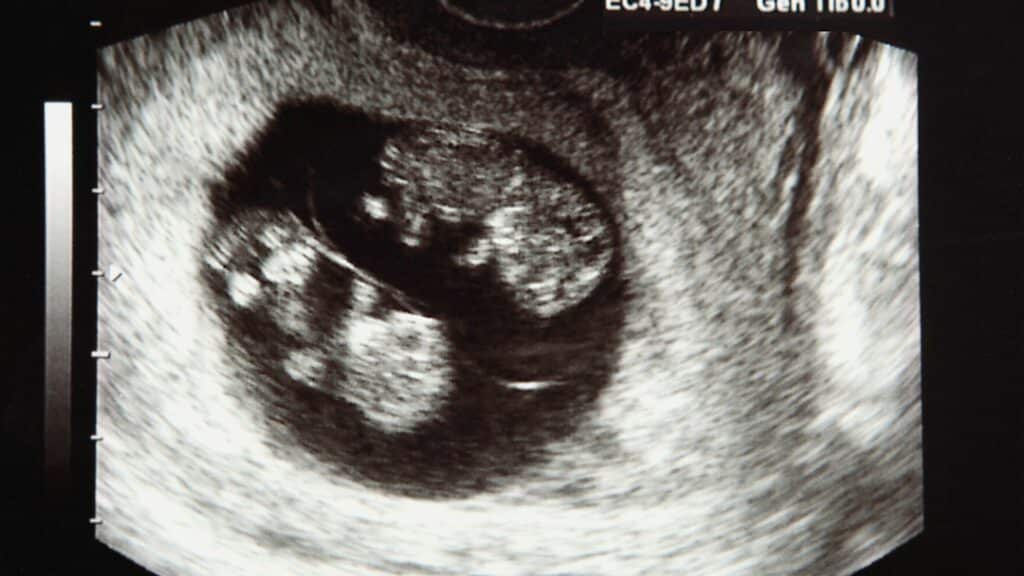 Imagem de um ultrassom de uma mulher grávida de gêmeos