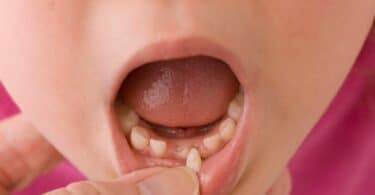 Imagem da boca de uma criança que está com o dente nascendo