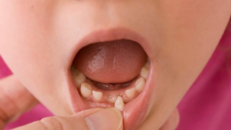 Imagem da boca de uma criança que está com o dente nascendo